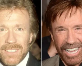 chuck-norris-before-and-after-plastic-surgery