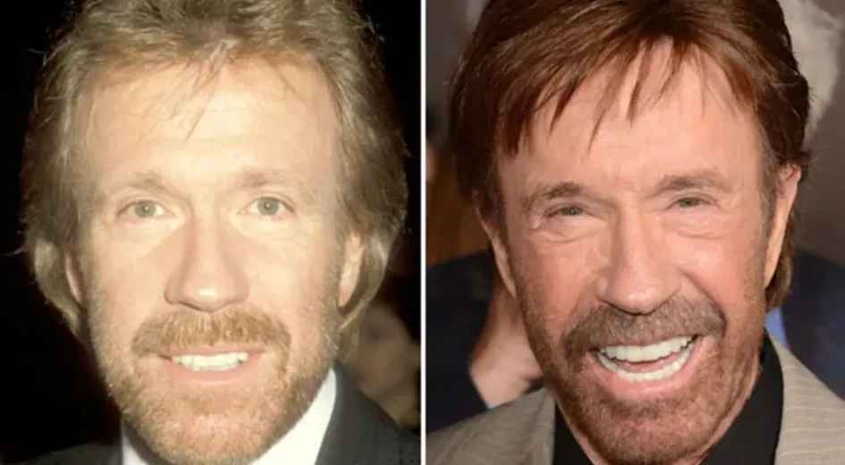 chuck-norris-before-and-after-plastic-surgery